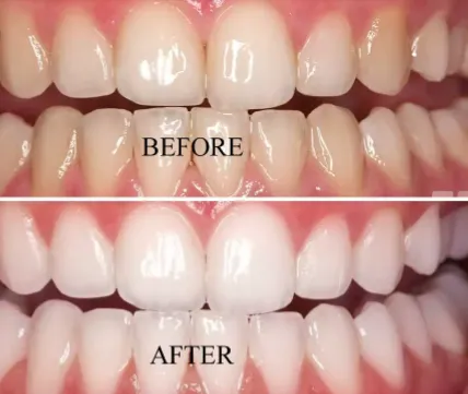 27566 teeth whitening uk before after