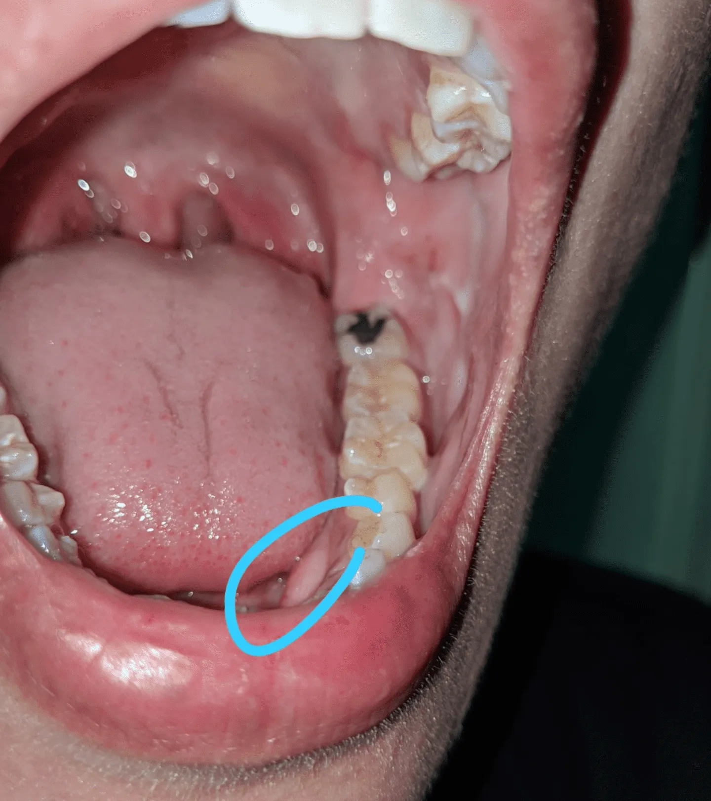 27575 enamel erosion