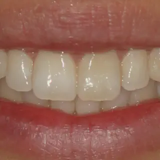 /img/27585-dental-professional-teeth-whitening.webp
