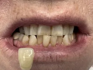 27585 teeth whitening process