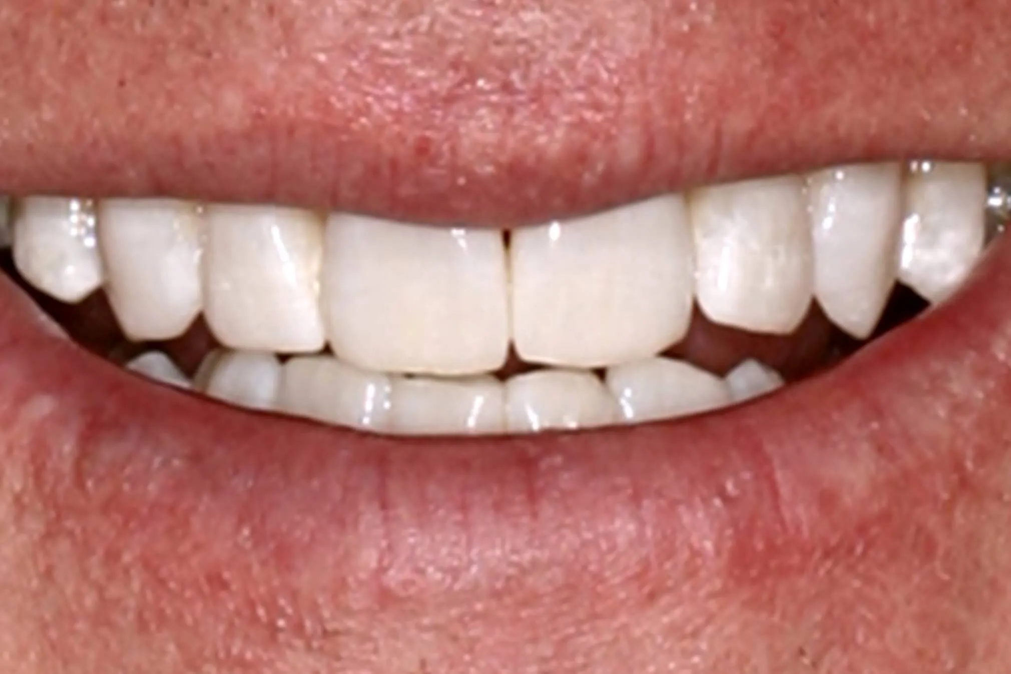 27585 teeth whitening sensitive teeth