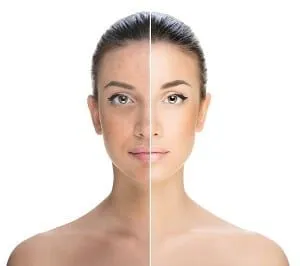 27589 laser whitening vs other methods