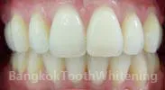 27594 professional teeth whitening