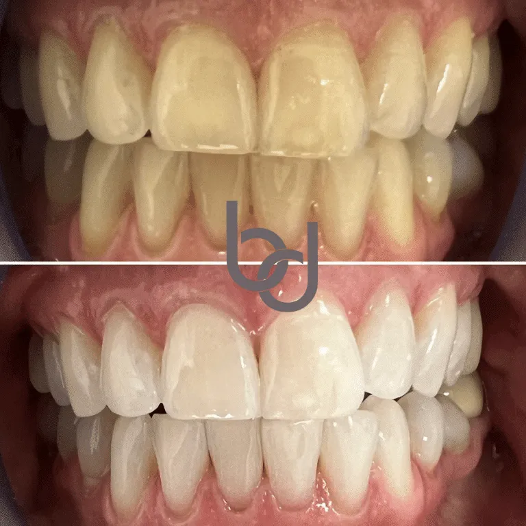 27597 teeth whitening cost