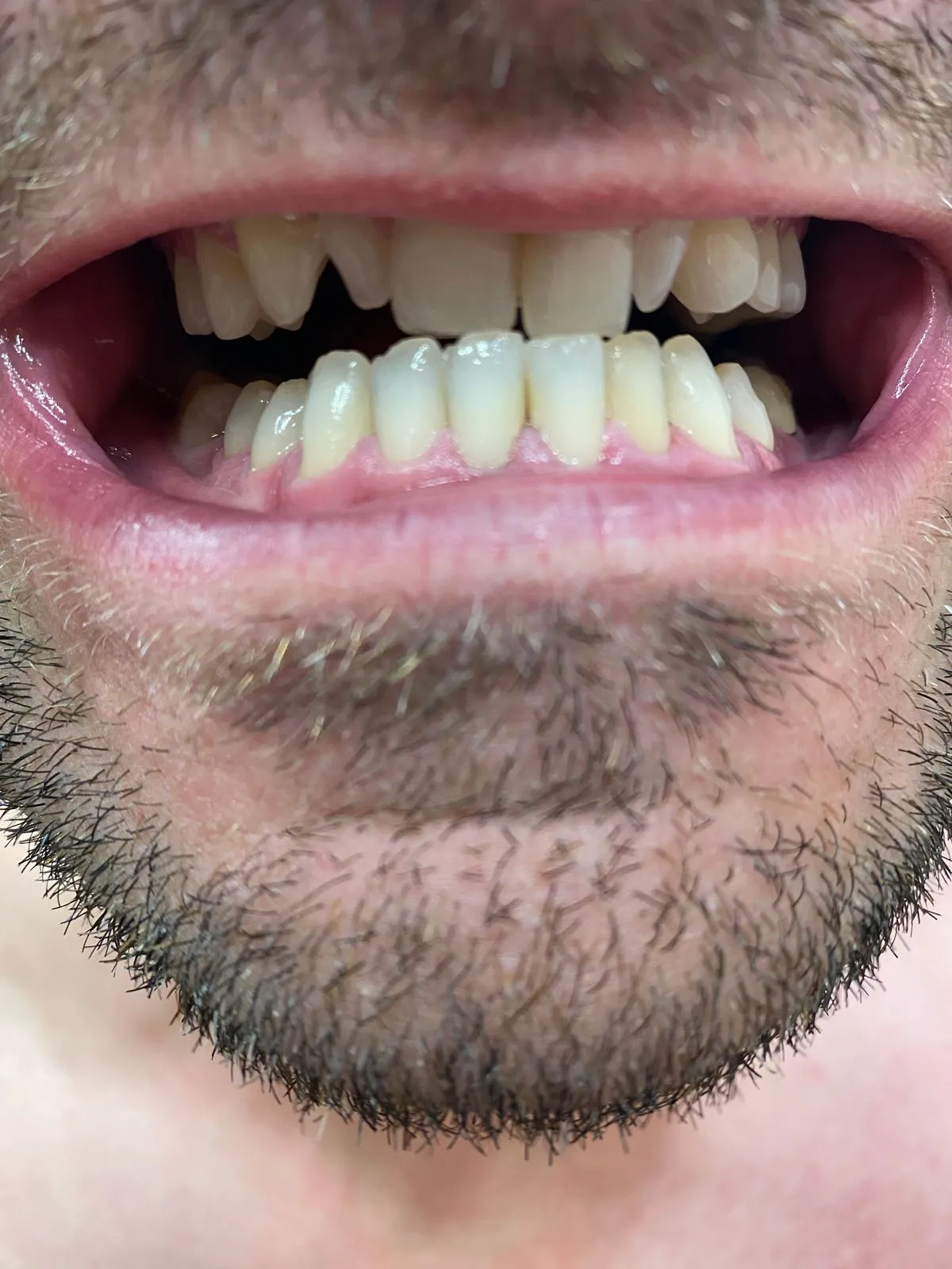 27601 teeth whitening maintenance