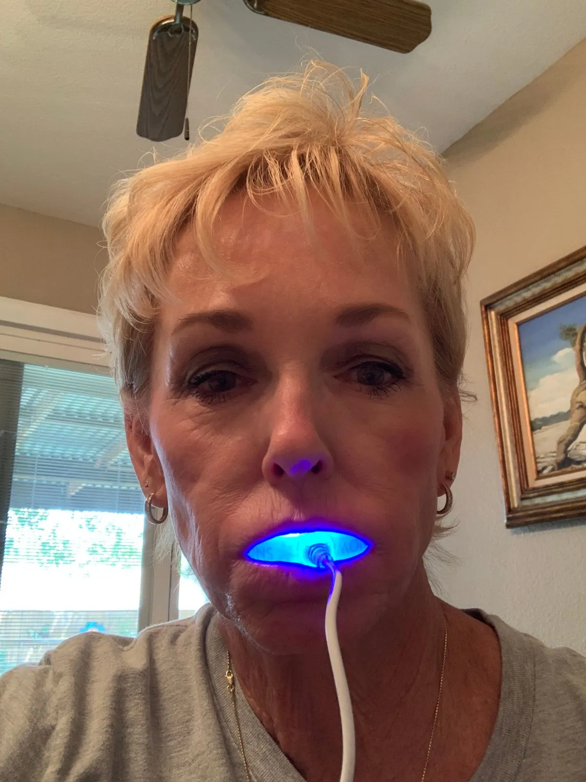 27601 teeth whitening results