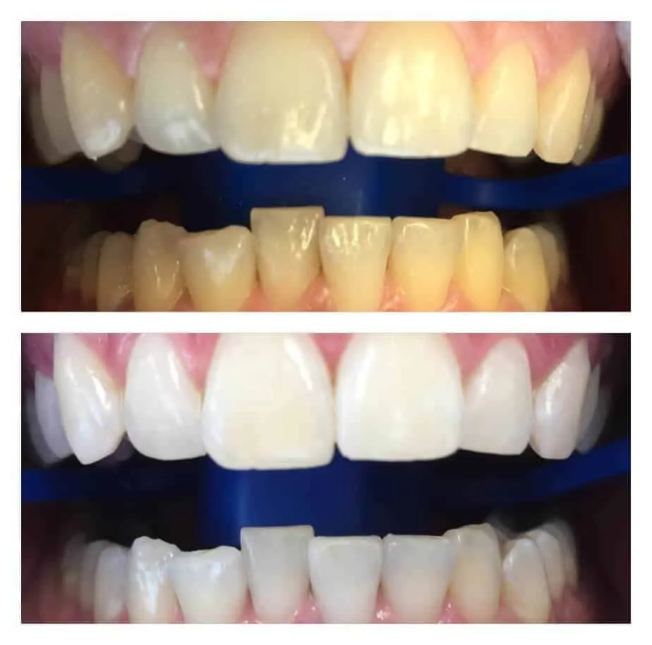 27604 teeth whitening cape coral fl 3
