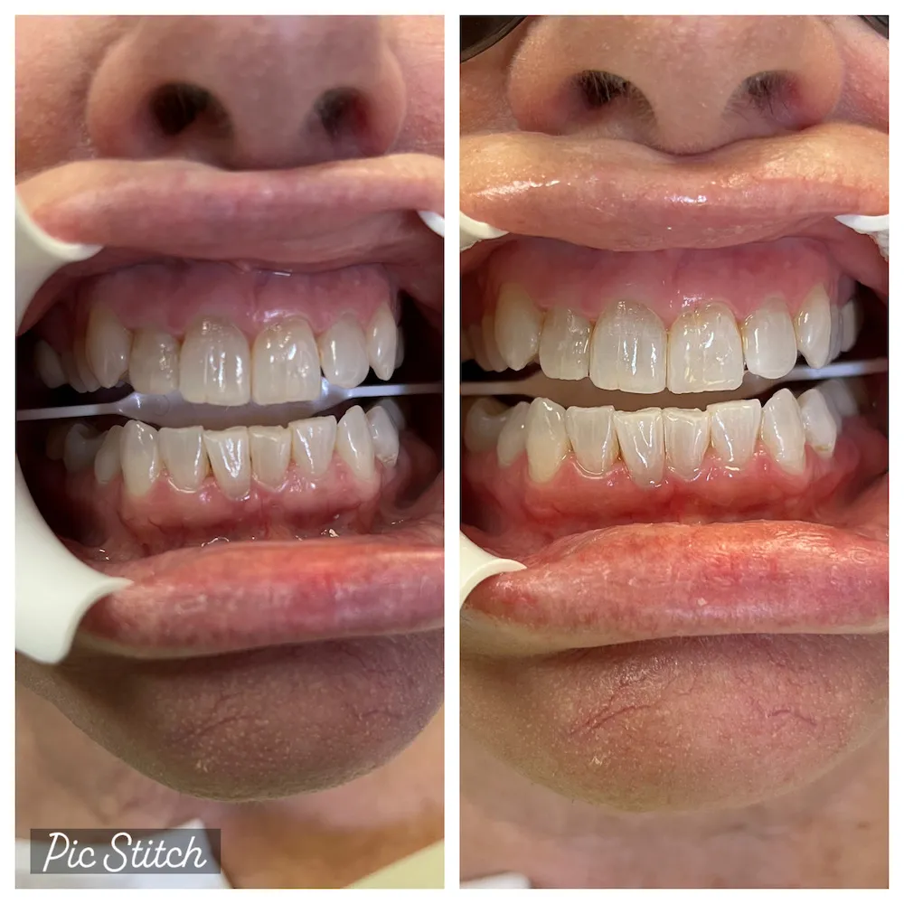 27604 teeth whitening cape coral fl 7