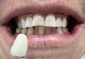 27625 oral hygiene routine