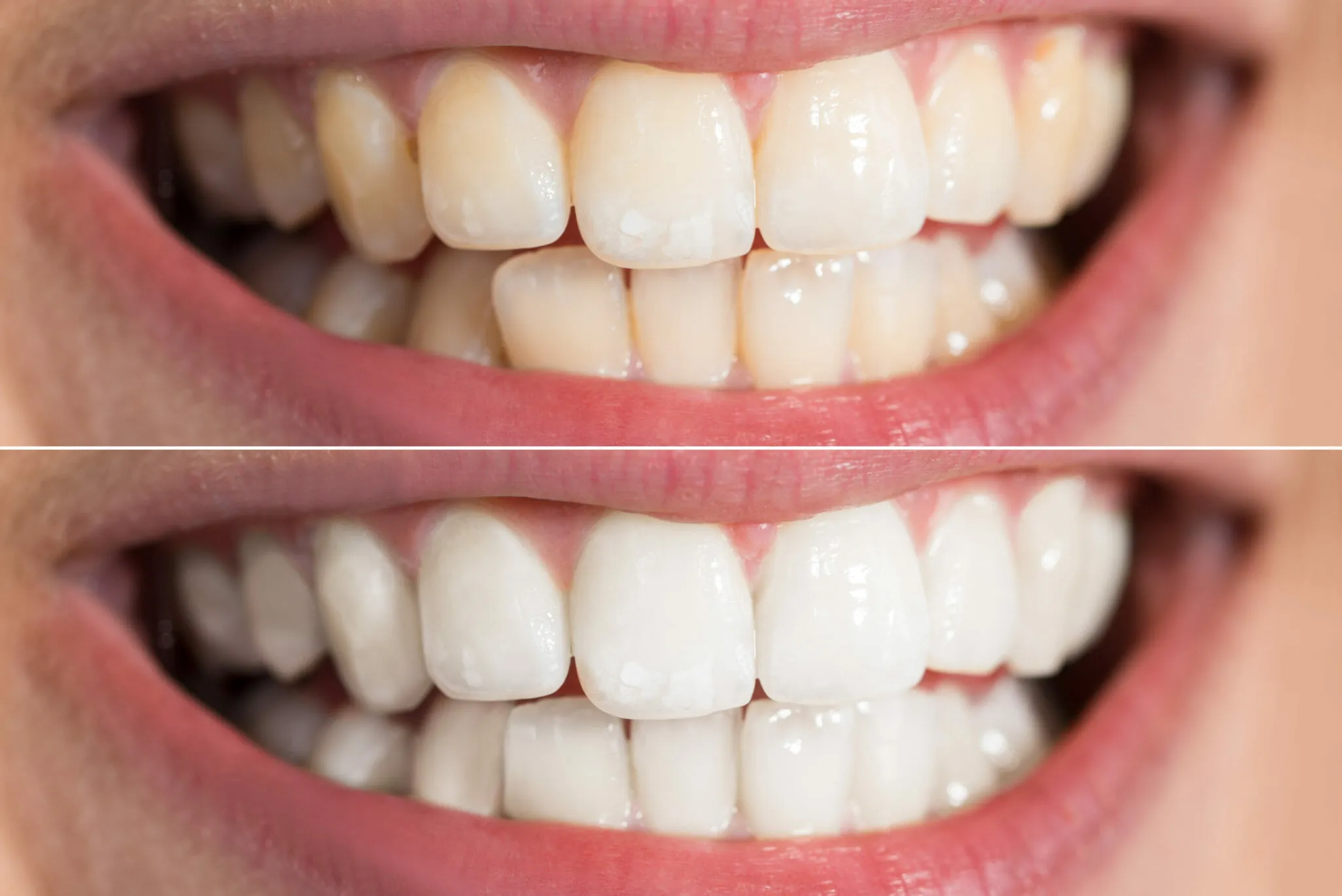 /img/27625-teeth-whitening-consultation.webp