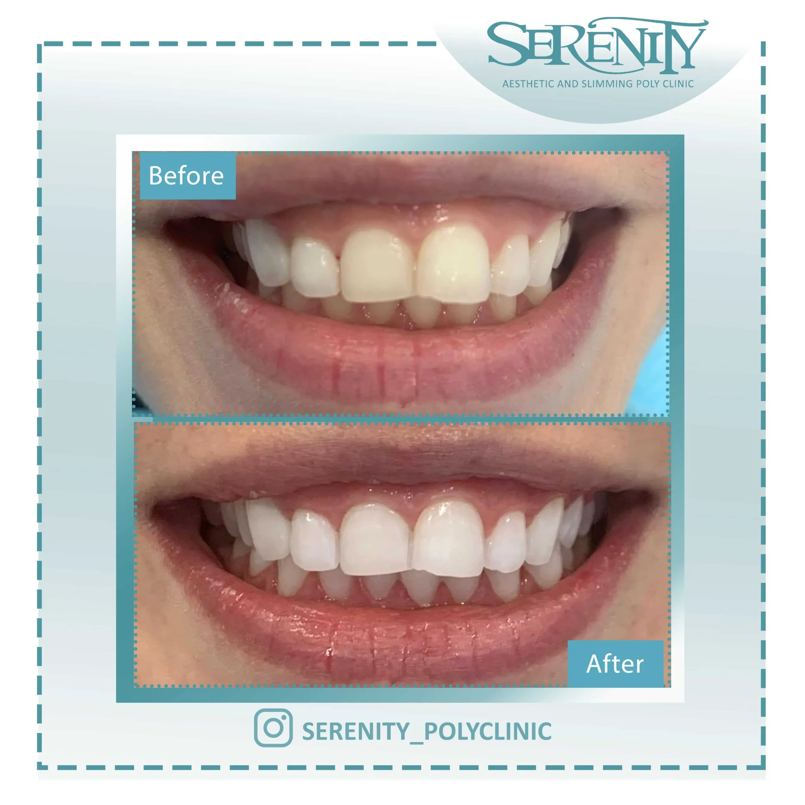 27668 teeth whitening dubai before after