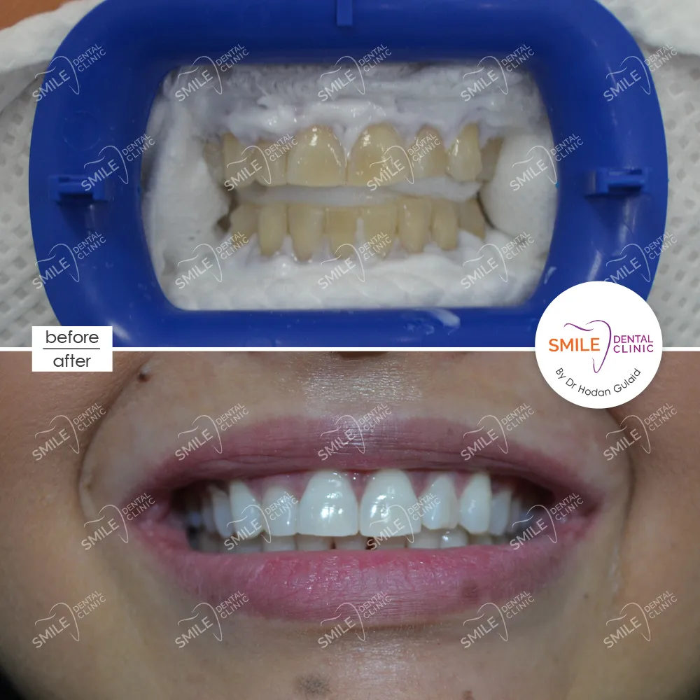 27668 teeth whitening results