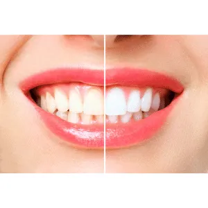 27670 teeth whitening sensitivity
