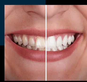 27671 teeth whitening ballito oral health
