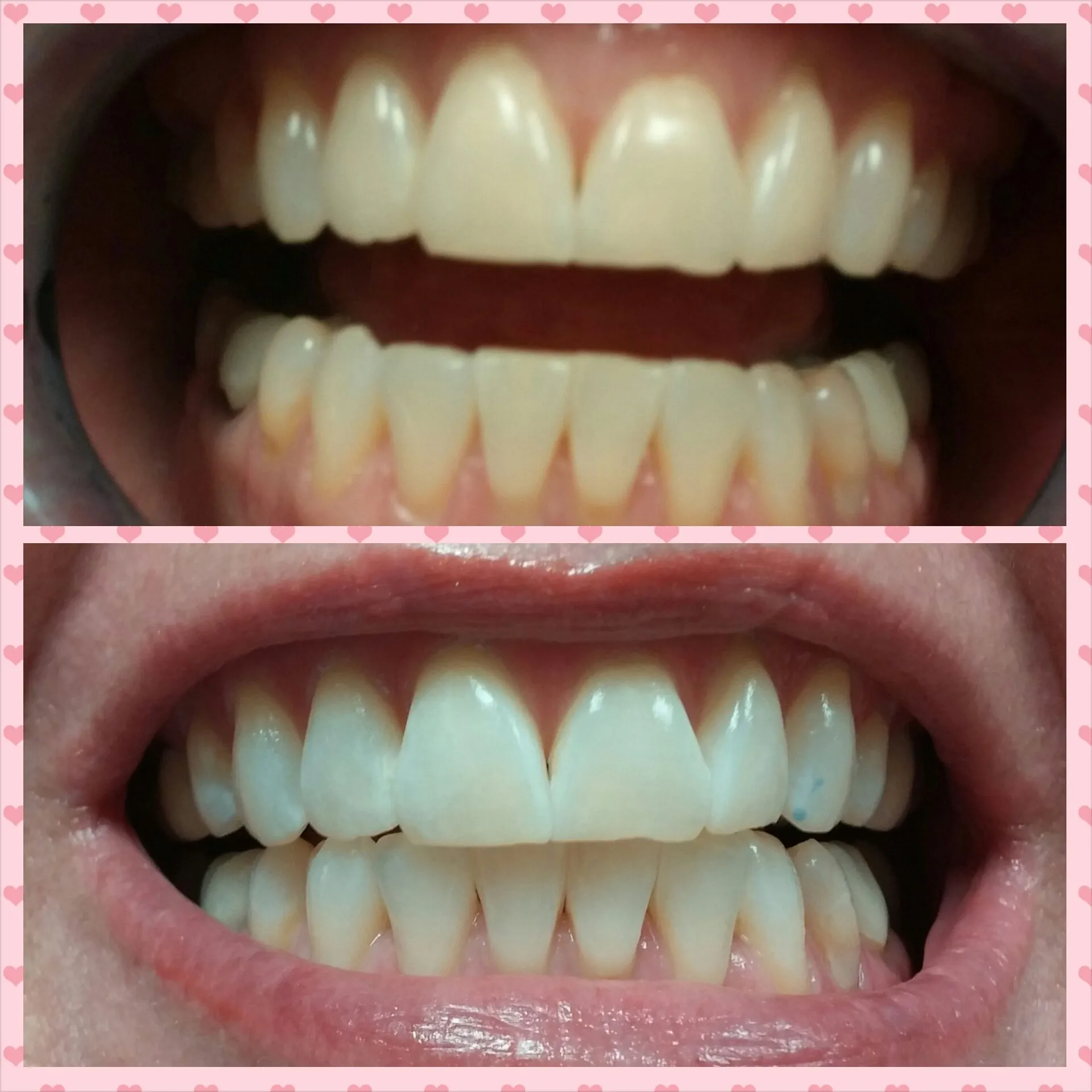 27675 spot 1 teeth whitening