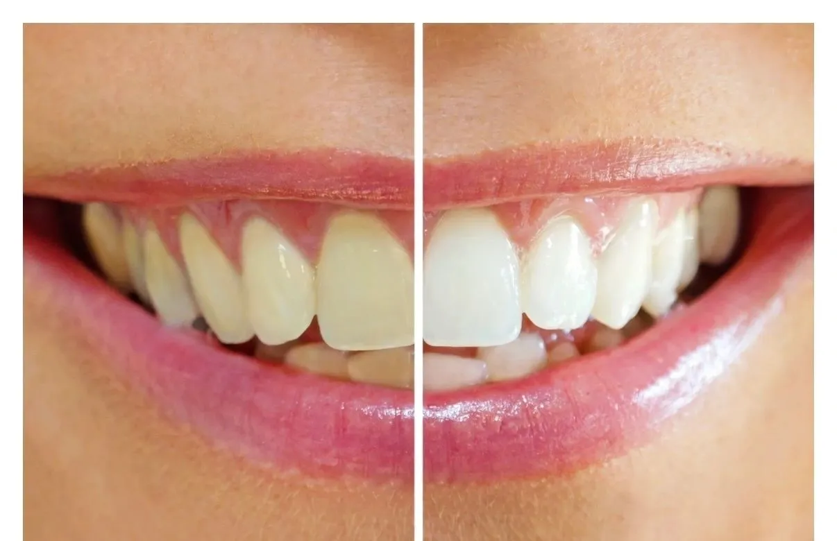 27678 uphoria whitening process