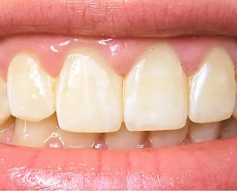 27681 teeth whitening maintenance