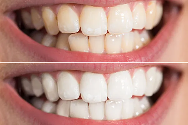 27685 teeth whitening spa aftercare