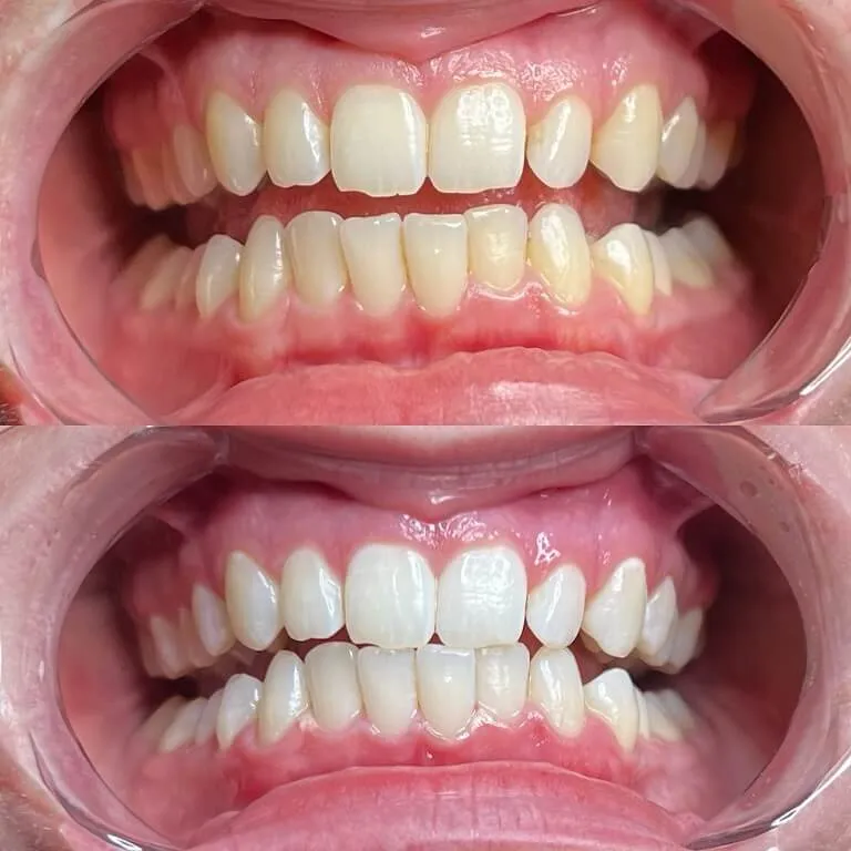 27685 teeth whitening spa reviews