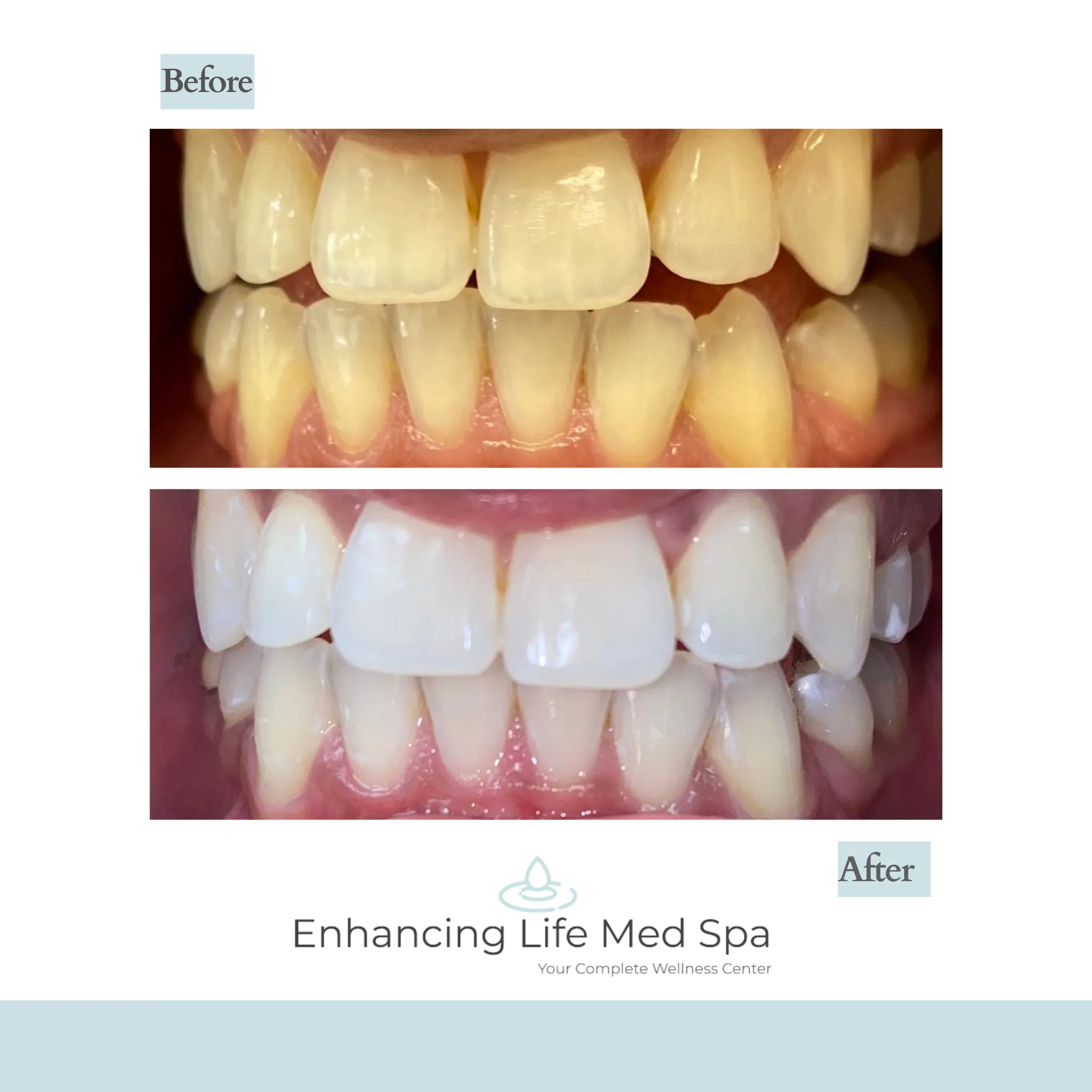 27685 teeth whitening spa smile