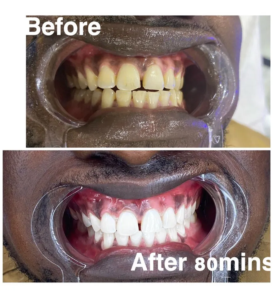 27685 teeth whitening spa treatment