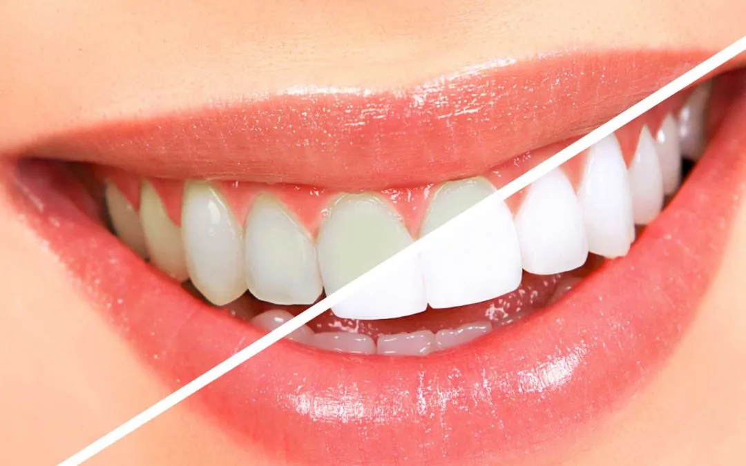 27702 teeth whitening enamel