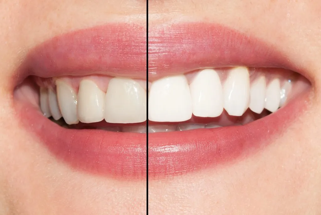 27702 teeth whitening procedures