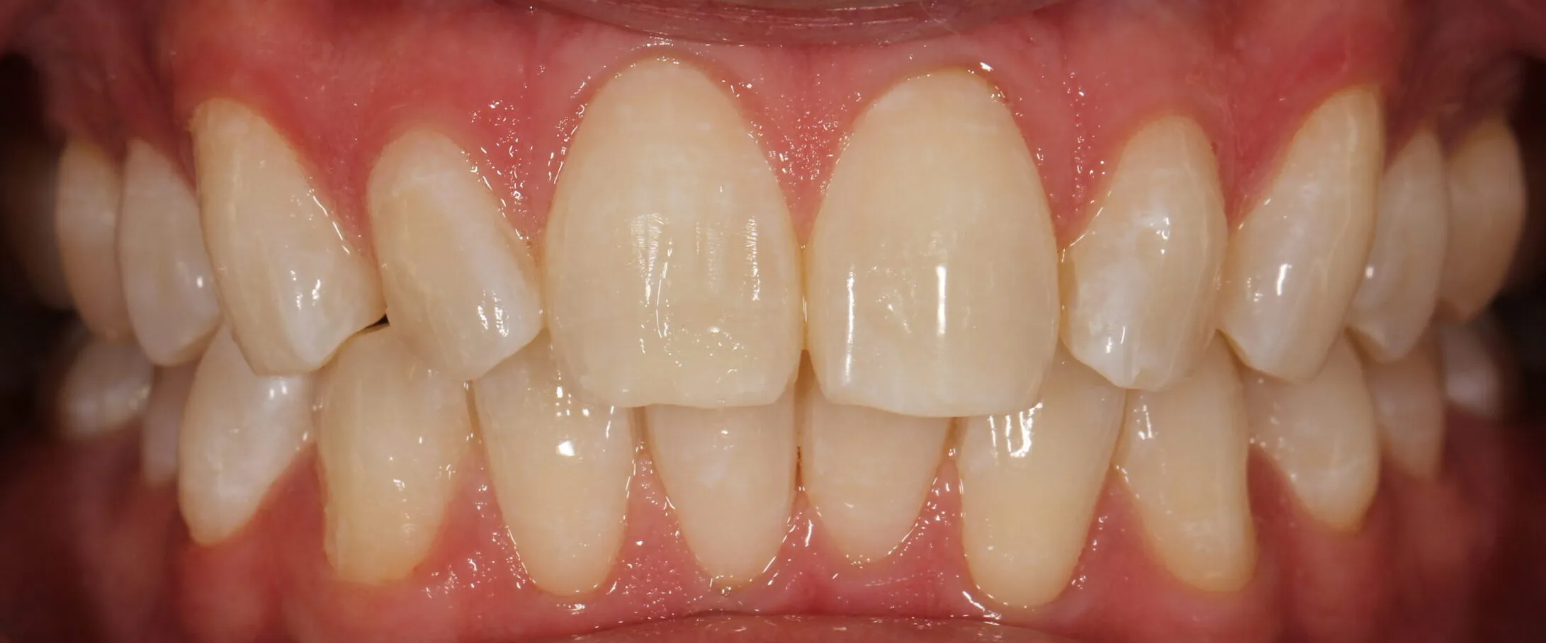 27712 enamel dehydration