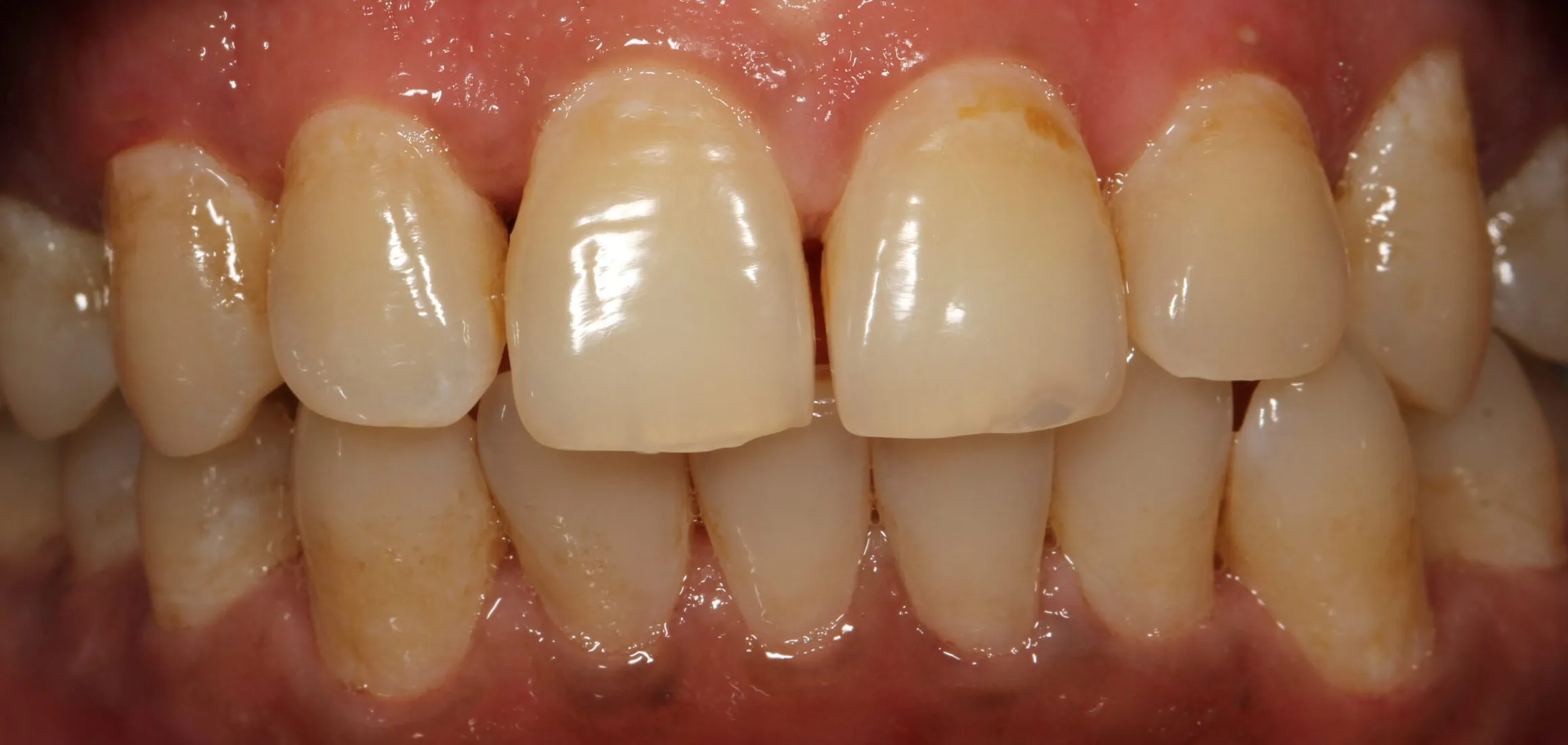 27712 tooth sensitivity