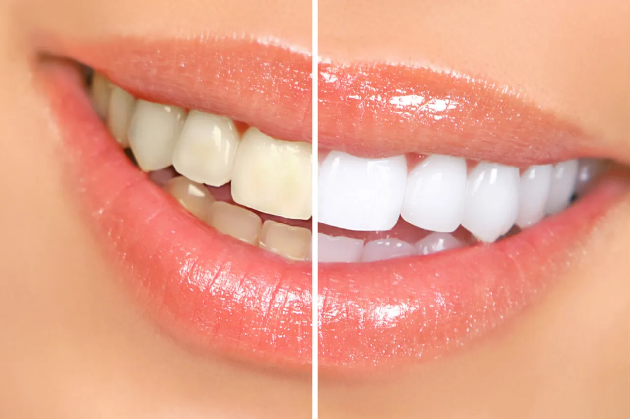 27717 professional teeth whitening