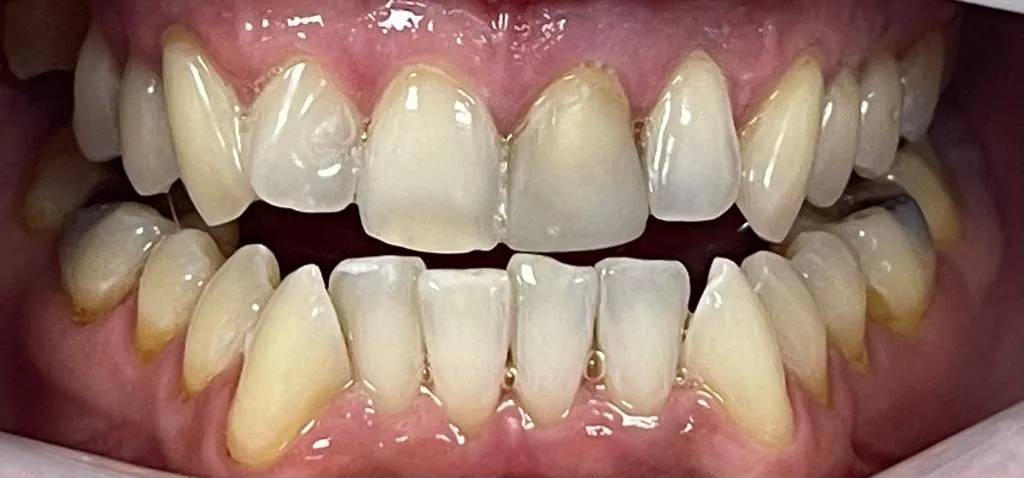 27723 dehydrated teeth