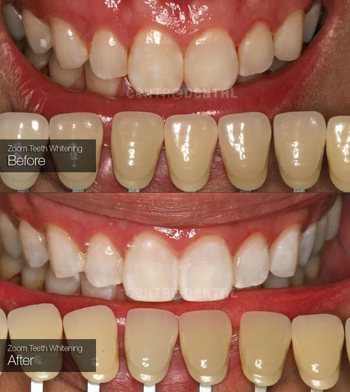 27723 zoom teeth whitening procedure
