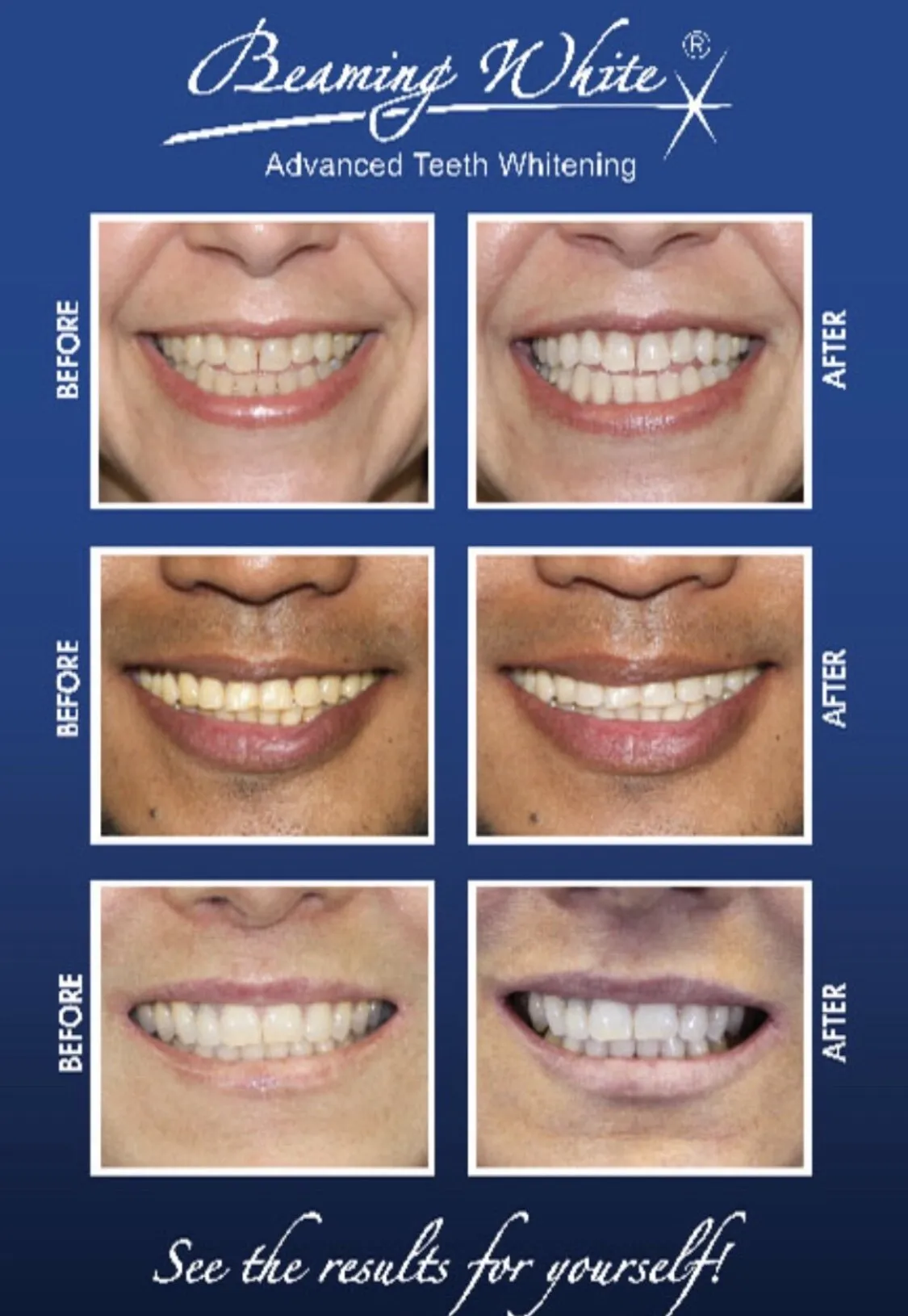 27725 teeth whitening results