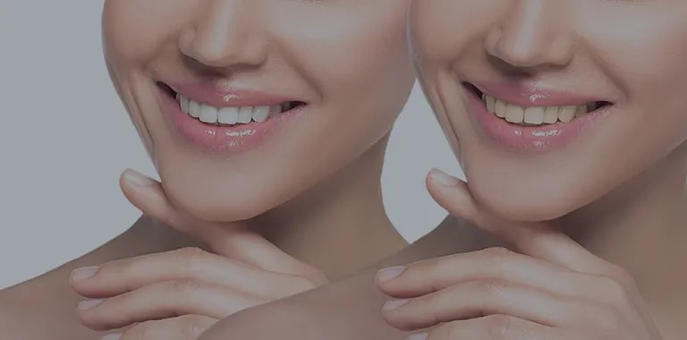 27736 teeth whitening before after