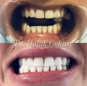 27750 at home teeth whitening