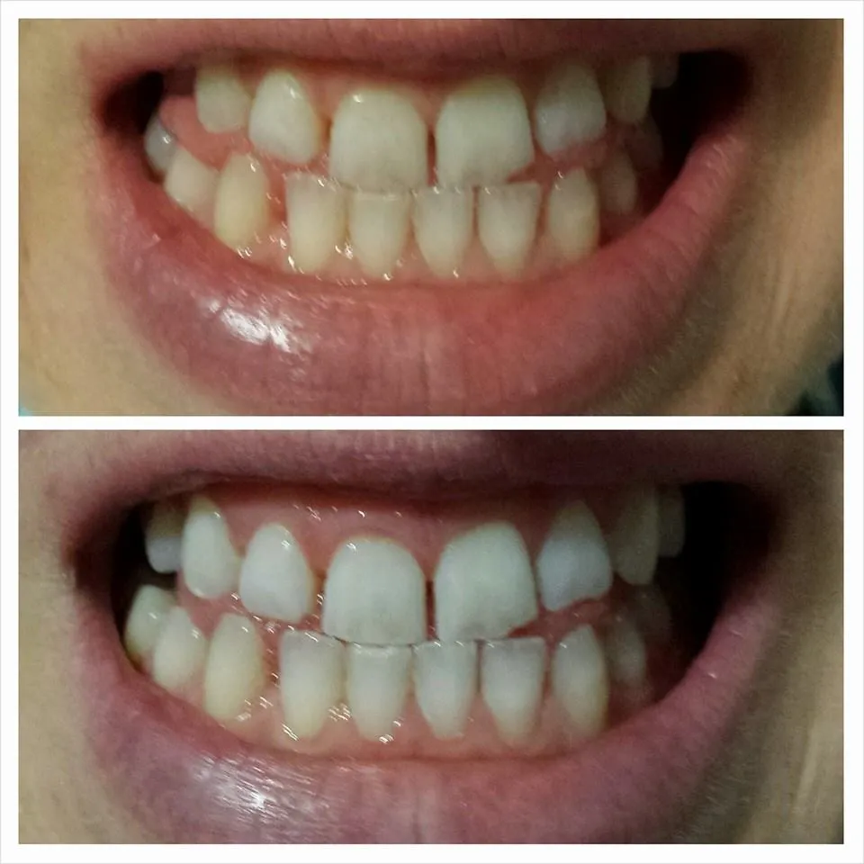 27751 teeth whitening before after
