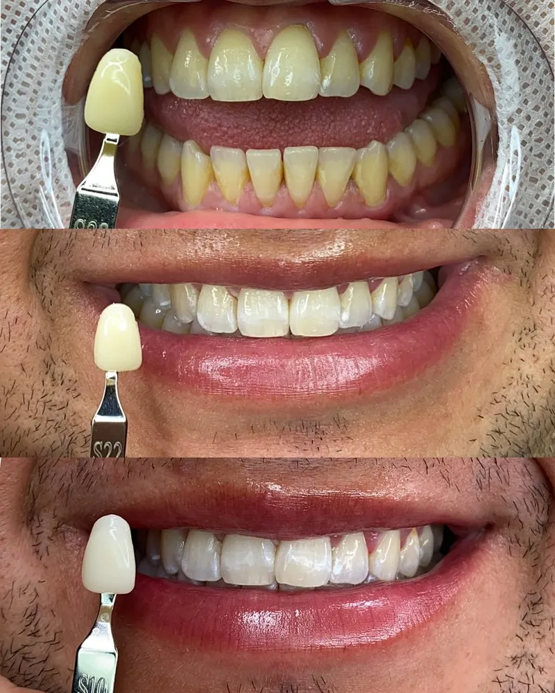 27751 teeth whitening comparison