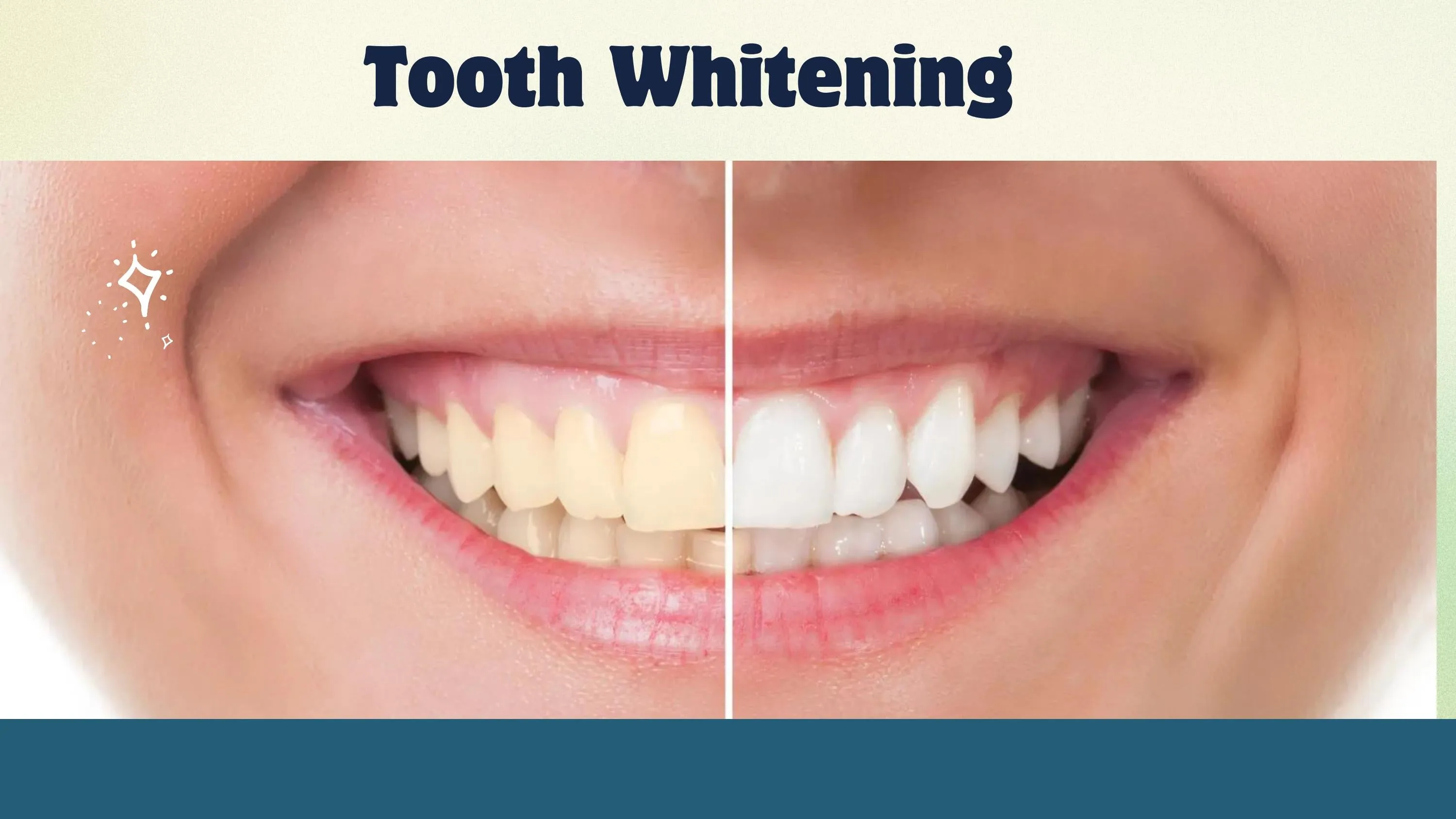 /img/27766-professional-teeth-whitening.webp