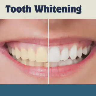 /img/27766-professional-teeth-whitening.webp