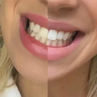 /img/27768-whitening-results.webp