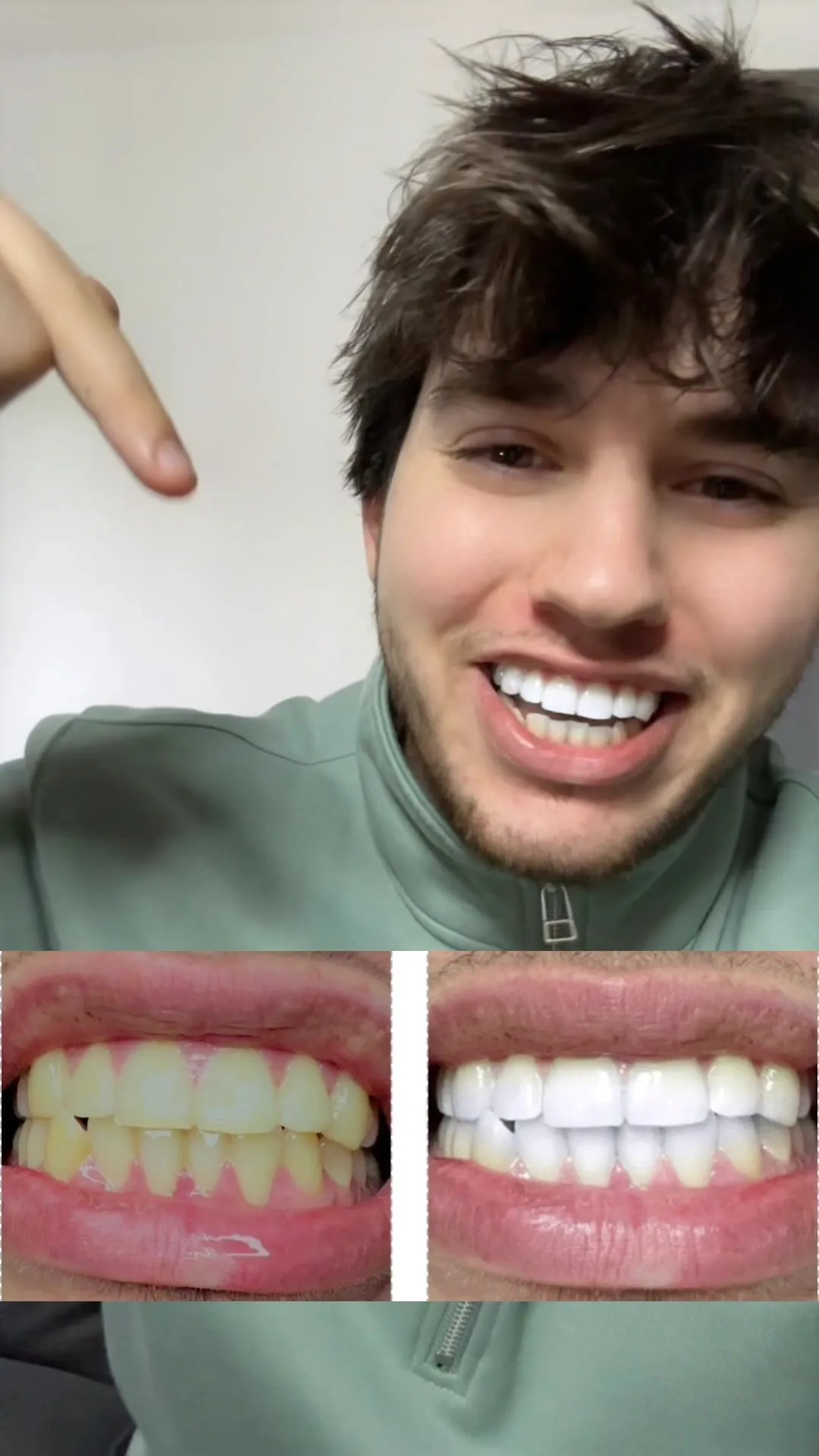 27775 rinsing teeth after whitening