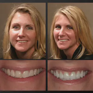 /img/27781-teeth-whitening-dorchester-maintaining.webp