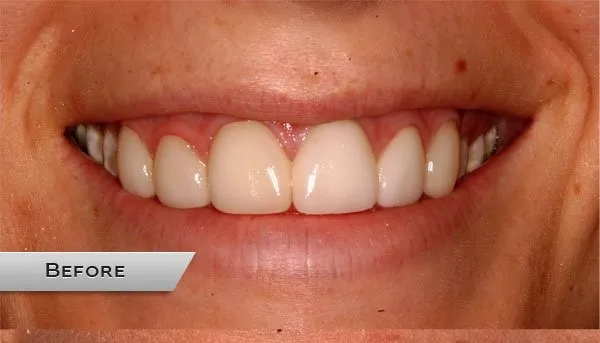 27782 tooth discoloration