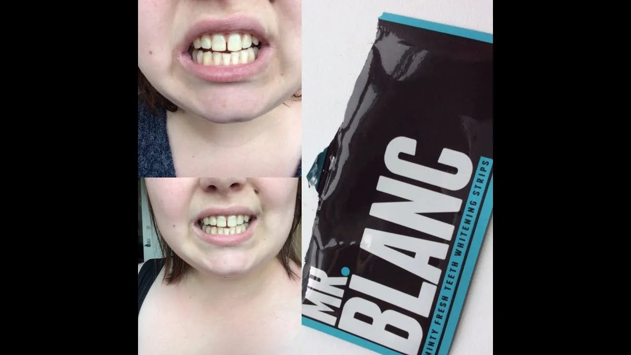 27787 teeth whitening kit components