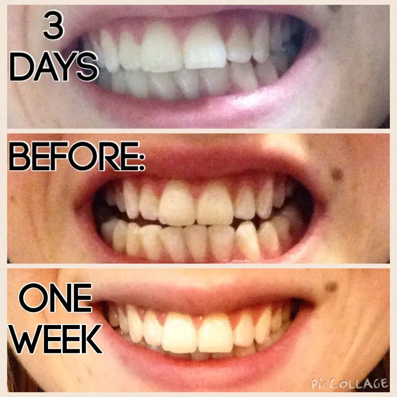 27787 teeth whitening strips application