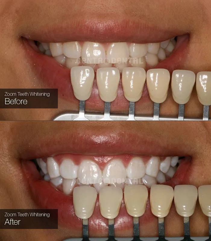 27789 zoom laser teeth whitening