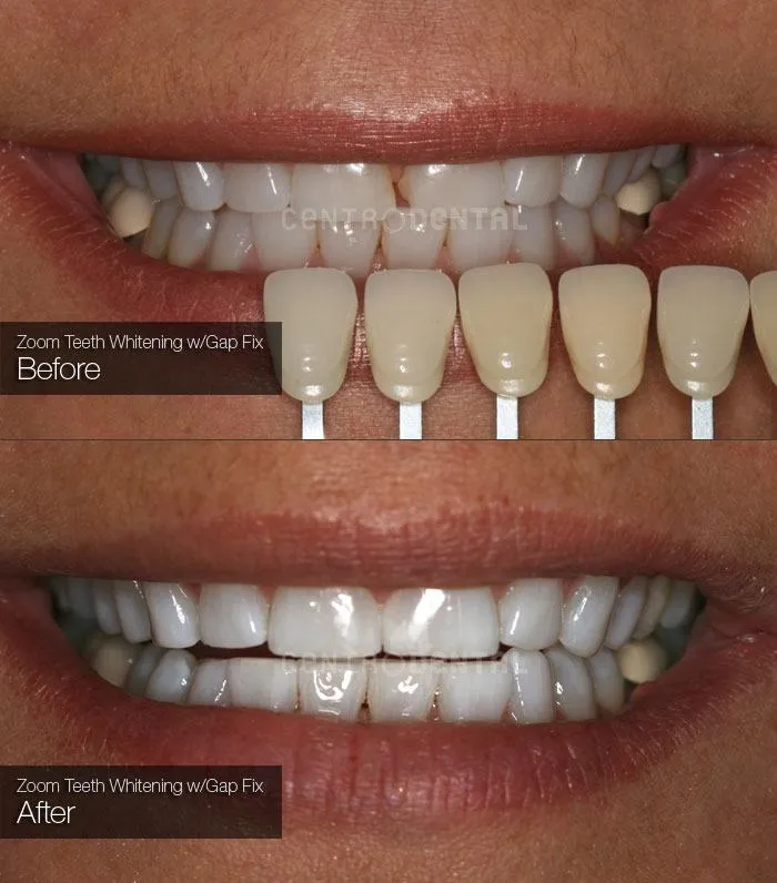 27791 zoom whitening gel