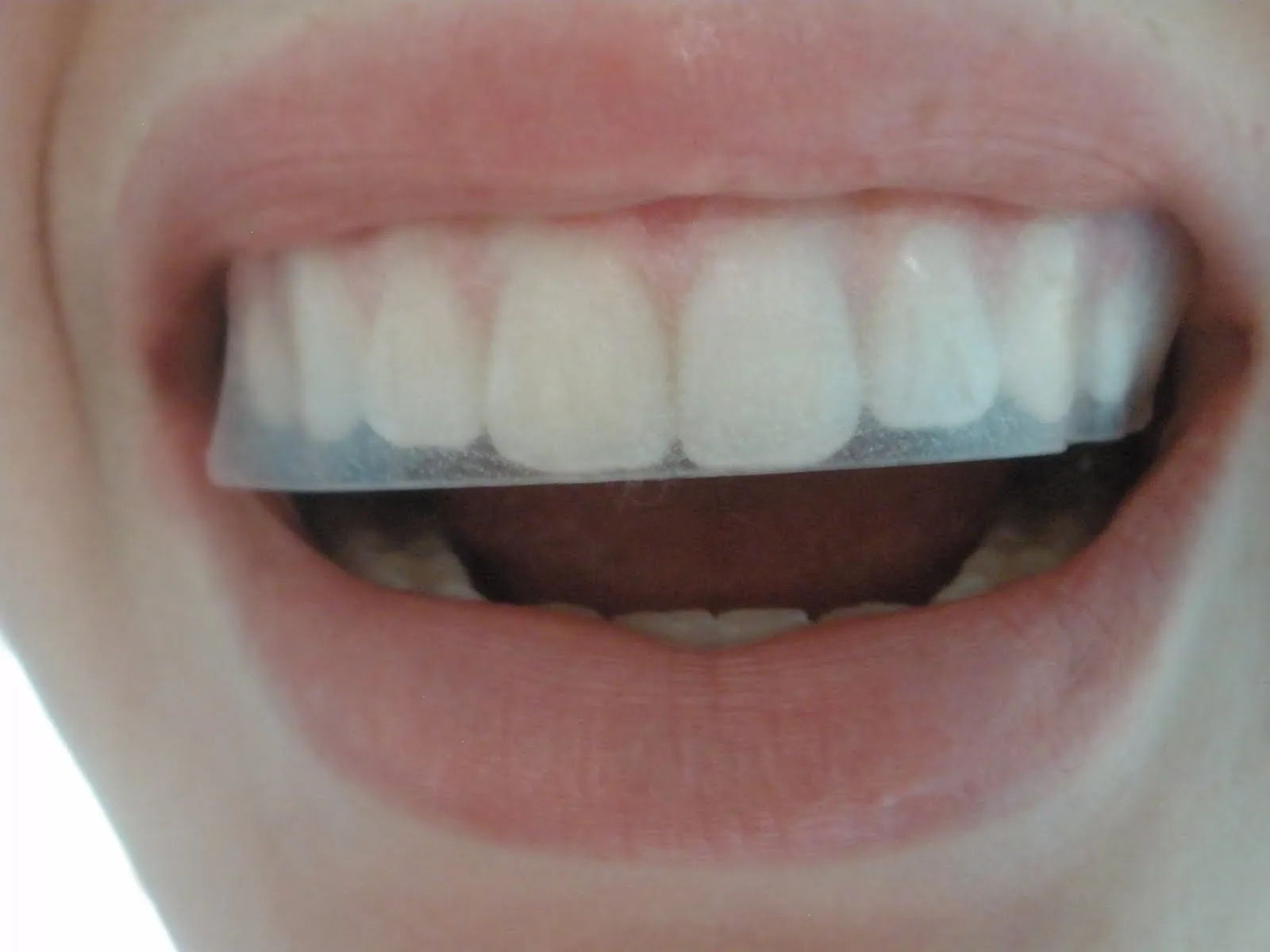 27796 whitening strips application