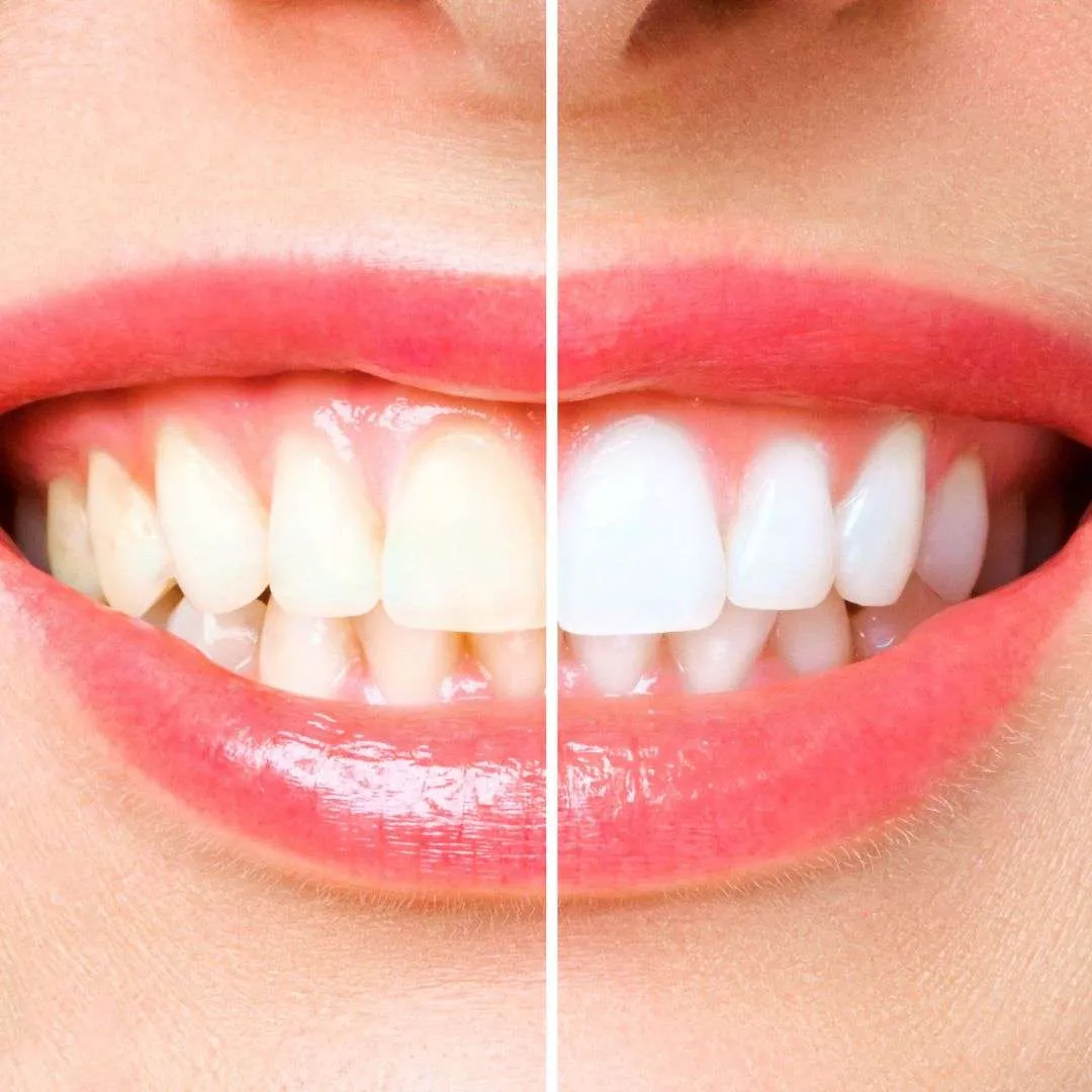 27798 baking soda teeth whitening