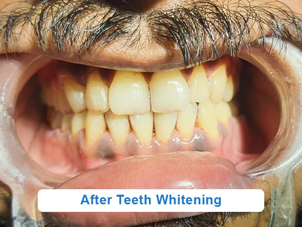 27801 teeth whitening kolkata image5